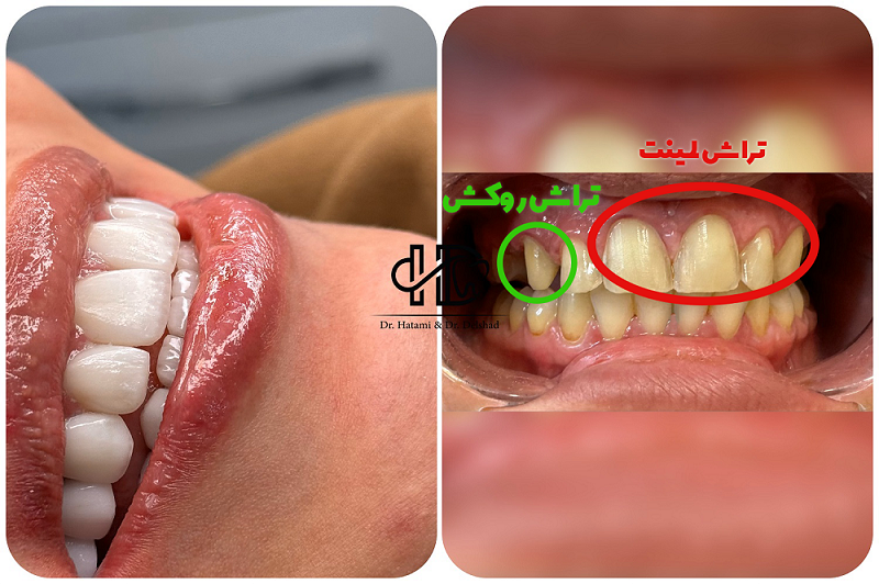 تفاوت تراش لمینت و روکش